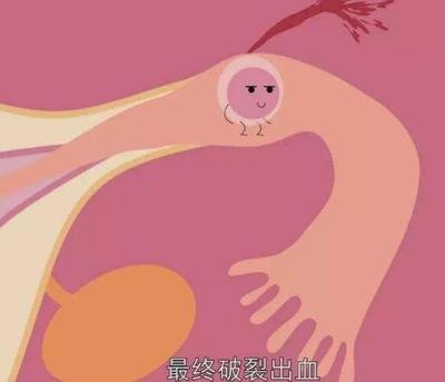 女性应该如何预防盆腔炎