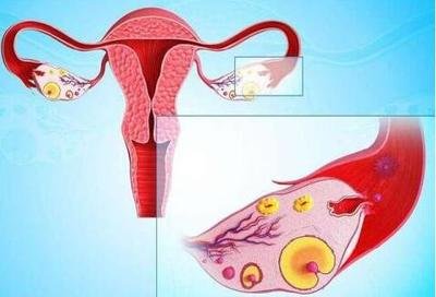 多囊不孕可以考虑试管婴儿辅助生养吗