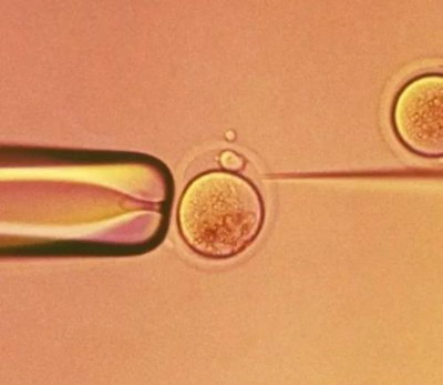 什么是输精管阻塞？男性不育后该怎么医治