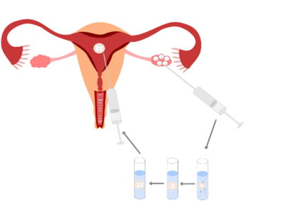 不孕夫妻进行试管婴儿医治需要经过哪些步骤