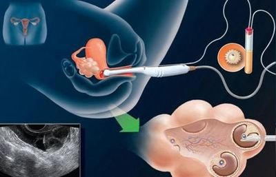 单身女性海外冻卵指南，嘉运国际守护您的生育能力